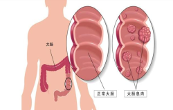 肠息肉会癌变吗？肠镜检查出肠息肉千万别大意！