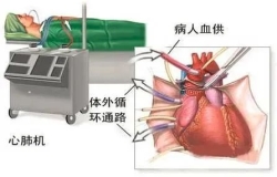 心外科团队中，体外循环那些事