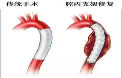 《问心》热播！全网热议的主动脉夹层，您了解吗？