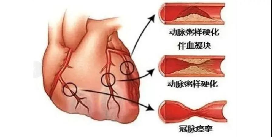 Important Medications for Coronary Heart Disease Patients That Should Never Be Stopped!